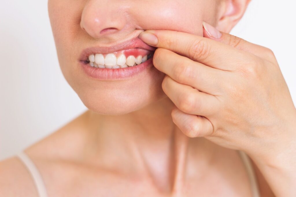 A close-up shot of the bottom half of a person's face. The person is pulling their upper left lip back, showing an inflamed portion of their gums.