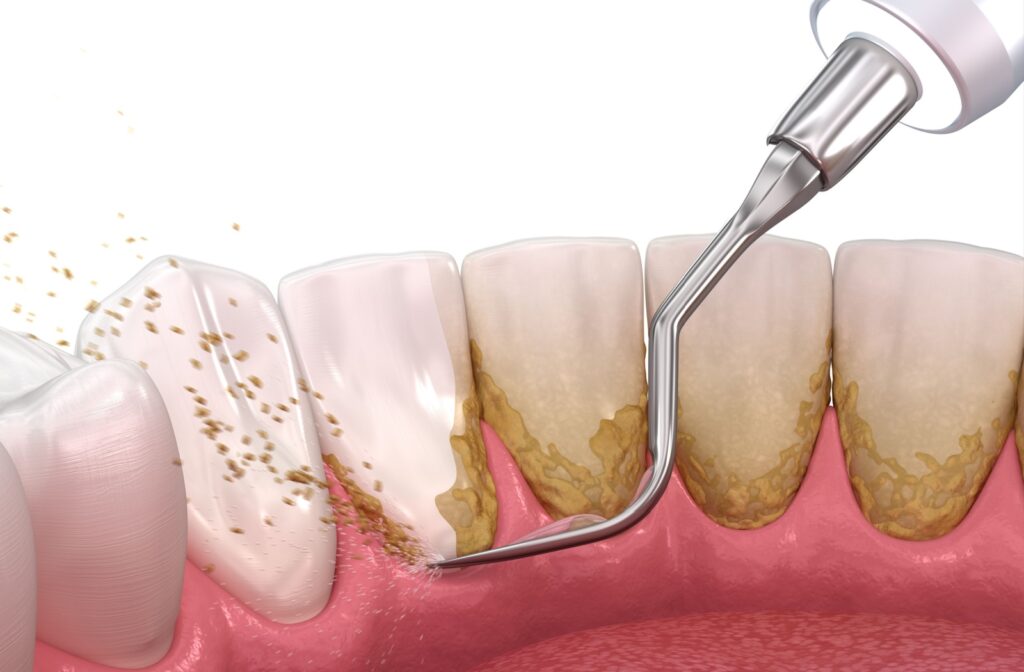 A graphic illustrates how dental scaling tools precisely and effectively remove tartar and plaque from the teeth and gumline.