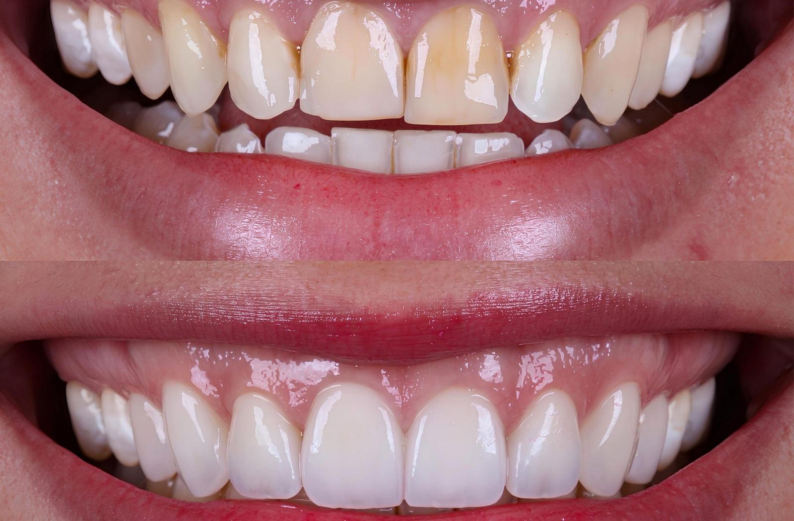 Before and after of teeth being whitened.