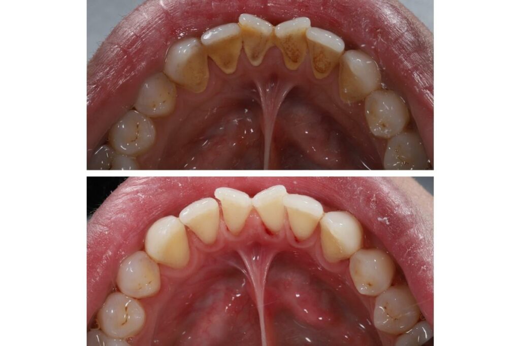 Top down photo of before and after tartar cleaning.