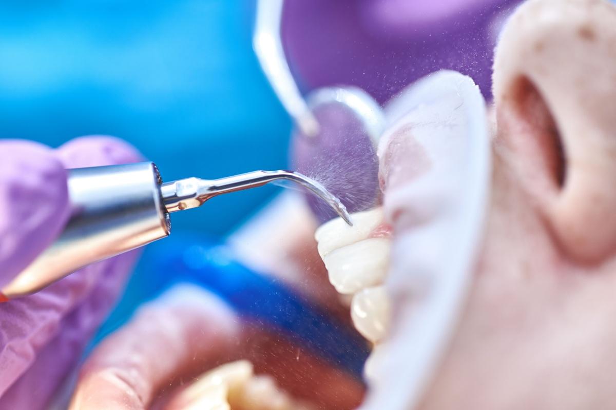 Up close image of an ultrasonic scaler patient used during teeth cleaning.