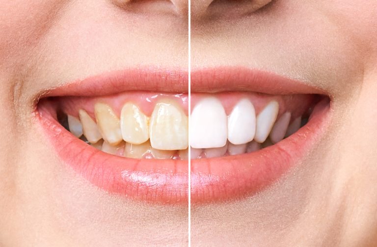 Before and after teeth whitening woman image