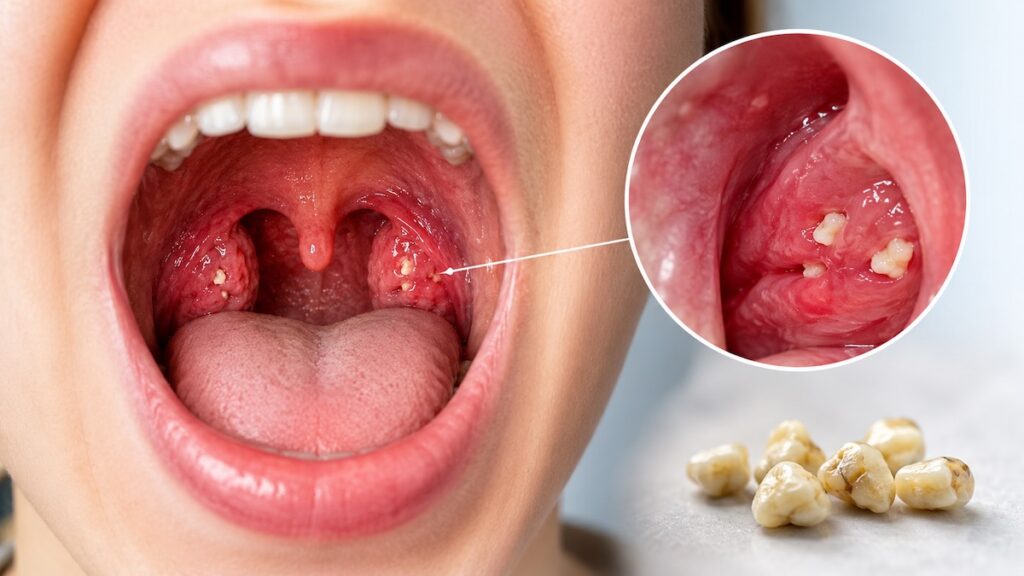 Close up image of tonsil stones.