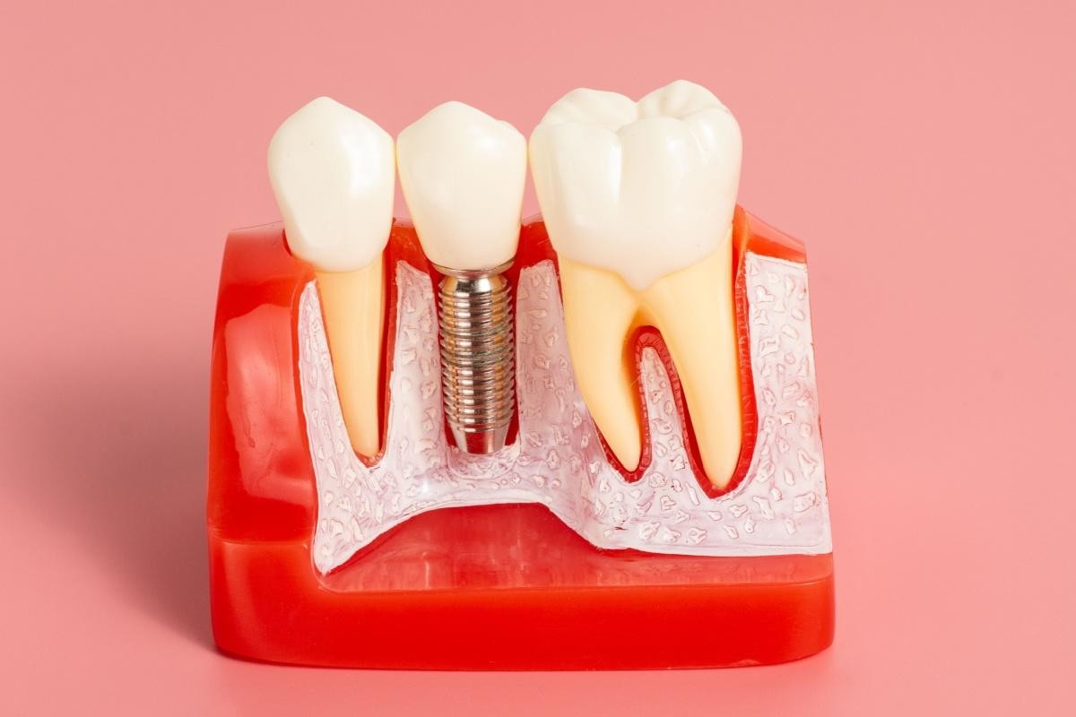 Dental implant model cross section.