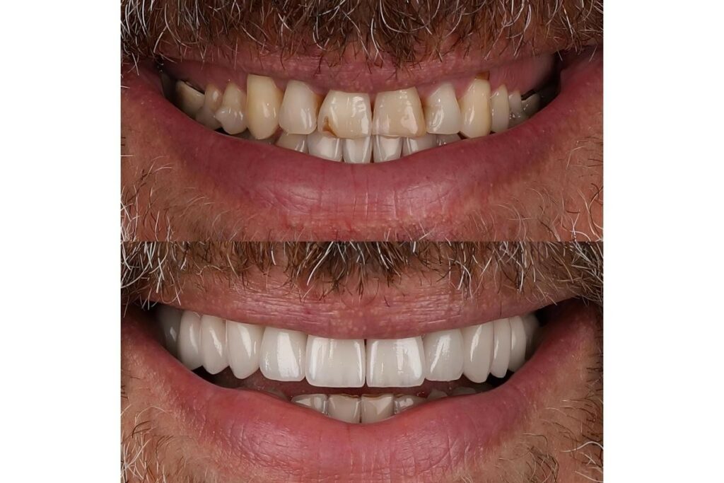 A split-screen comparison showing a man's smile before and after receiving dental veneers. The top image shows teeth with staining, gaps, and uneven wear. The bottom image shows a transformed smile with bright, uniform, and perfectly aligned white teeth.