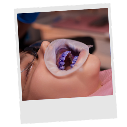 Sundance Dental Clinic Air Polish Gallery 2
